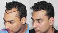 Medispa Hair Transplant Center
Ph : +91-8527220878, +91-8527220815 
Email: info@medispaindia.in