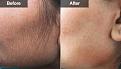 https://www.dynamiclinic.com.pk/laser-treatments/laser-hair-removal/