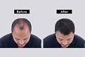 hair transplant in delhi