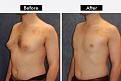 gynecomastia surgery in delhi