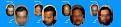 hair transplant before after dermalife