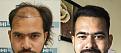 Result 5500 hair, 7 months result