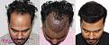 Hair Transplant Results at Medispa IndiaUpload