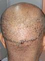 Healing after 3 days of hair transplant FUT + FUE method