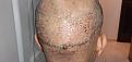 after 1 day of  Hair transplant surgery using both FUT + FUE method