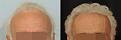 beard hair transplant 2000g n6 front