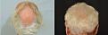 beard hair transplant 2000g n6 crown