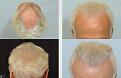 beard hair transplant 2000g n6 mixed