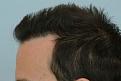 after hairline left