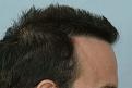 after hairline right