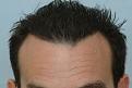 after hairline