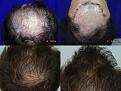 before after crown comparison