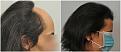 women hair transplant