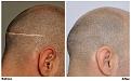 before after fue scar right side