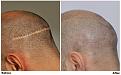 before after fue scar left side