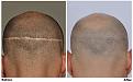 before after fue scar back