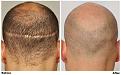 before after fue scar back2