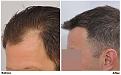 patient nnb before after left wet