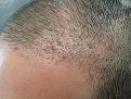 patient nnb after 3 months left side