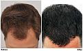 patient nnb before dry after top wet