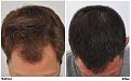 patient nnb before after top dry