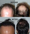before after top crown