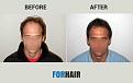 before after front