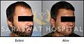 Hair Transplant Before After Results in Agra