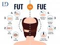 FUE vs FUT For website
