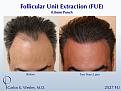 52-year-old man underwent a follicular unit extraction(FUE) session with Dr. Carlos K. Wesley in which a total of 2527

CARLOS K. WESLEY, MD (NYC)
Ph (844) 745-6362
INFO@DRCARLOSWESLEY.COM