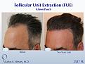 52-year-old man underwent a follicular unit extraction(FUE) session with Dr. Carlos K. Wesley in which a total of 2527

CARLOS K. WESLEY, MD (NYC)
Ph (844) 745-6362
INFO@DRCARLOSWESLEY.COM