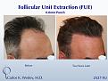 52-year-old man underwent a follicular unit extraction(FUE) session with Dr. Carlos K. Wesley in which a total of 2527

CARLOS K. WESLEY, MD (NYC)
Ph (844) 745-6362
INFO@DRCARLOSWESLEY.COM