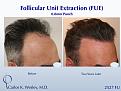 52-year-old man underwent a follicular unit extraction(FUE) session with Dr. Carlos K. Wesley in which a total of 2527

CARLOS K. WESLEY, MD (NYC)
Ph (844) 745-6362
INFO@DRCARLOSWESLEY.COM