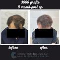 Procedure: FUE Hair Transplant
Number of grafts: 3000 Grafts
Results: 8 Months Post-op