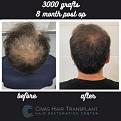 Procedure: FUE Hair Transplant
Number of grafts: 3000 Grafts
Results: 8 Months Post-op