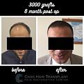 Procedure: FUE Hair Transplant
Number of grafts: 3000 Grafts
Results: 6 Months Post-op