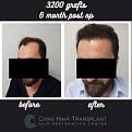 Procedure: FUE Hair Transplant
Number of grafts: 3200 Grafts
Results: 6 Months Post-op
