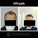 Procedure: FUE Hair Transplant
Number of grafts: 3200 Grafts